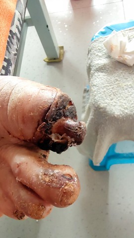 糖尿病脚趾头腐烂后脱落 糖尿病脚趾头腐烂后脱落