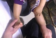 案例分享：原始點調理小孩蕁麻疹調理案例-原始點全球同學網