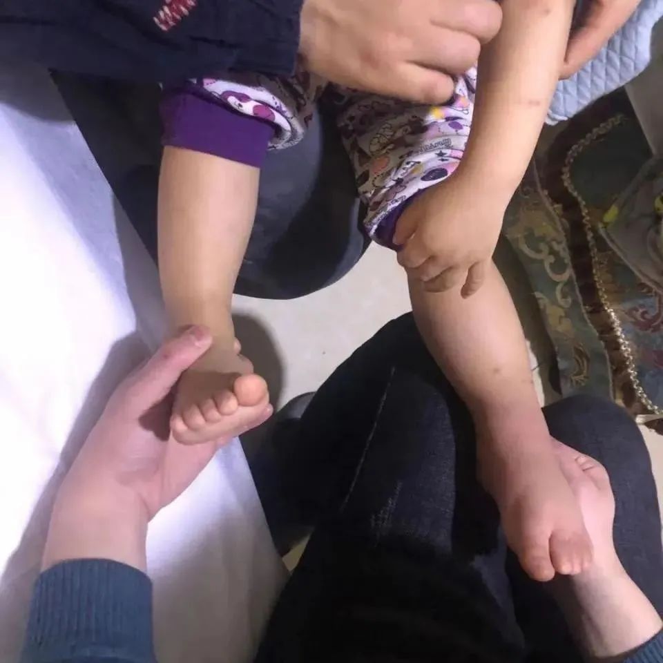 案例分享：原始点调理小孩荨麻疹调理案例-原始点全球同学网