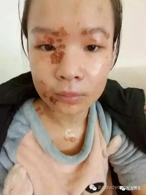 案例分享:花季少女面部烫伤不留疤的调理案例 案例分享:花季少女面部烫伤不留疤的调理案例