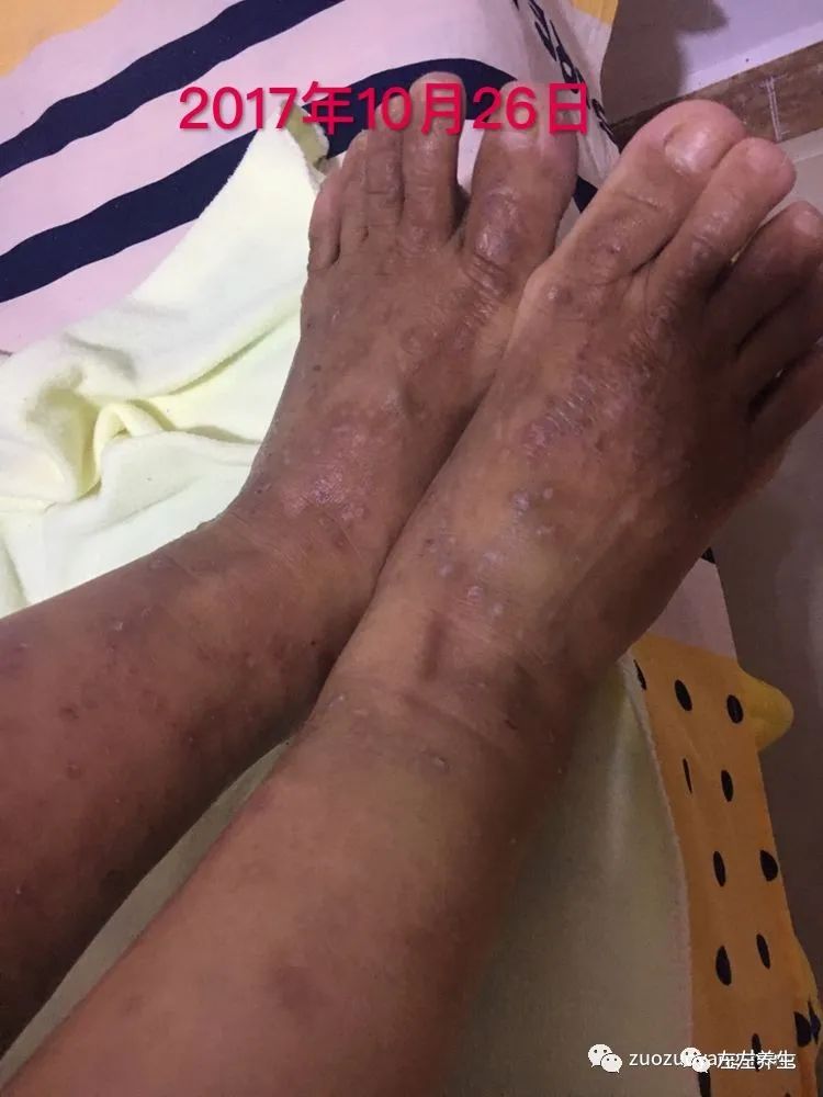 案例分享:全身奇痒无比的湿疹案例 案例分享:全身奇痒无比的湿疹案例
