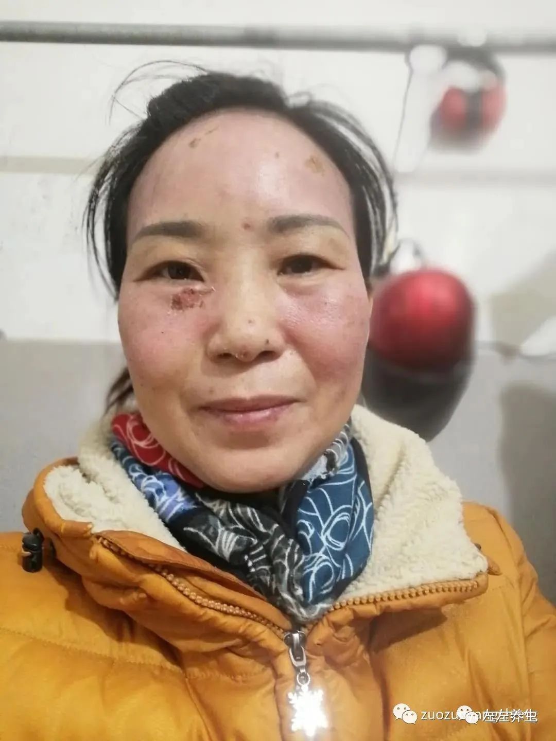 案例分享:脸上严重皮肤过敏调理案例 案例分享:脸上严重皮肤过敏调理案例