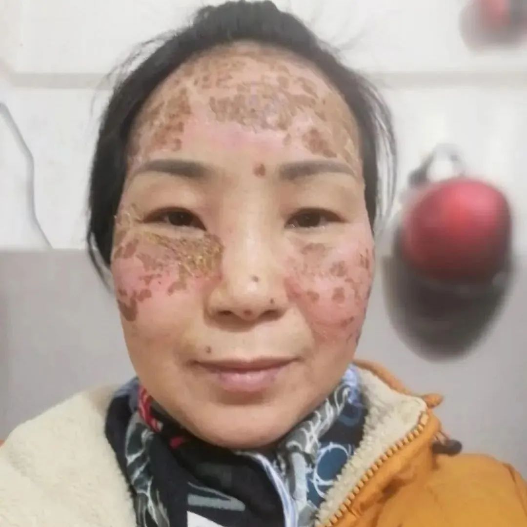 案例分享：脸上严重皮肤过敏调理案例-原始点全球同学网