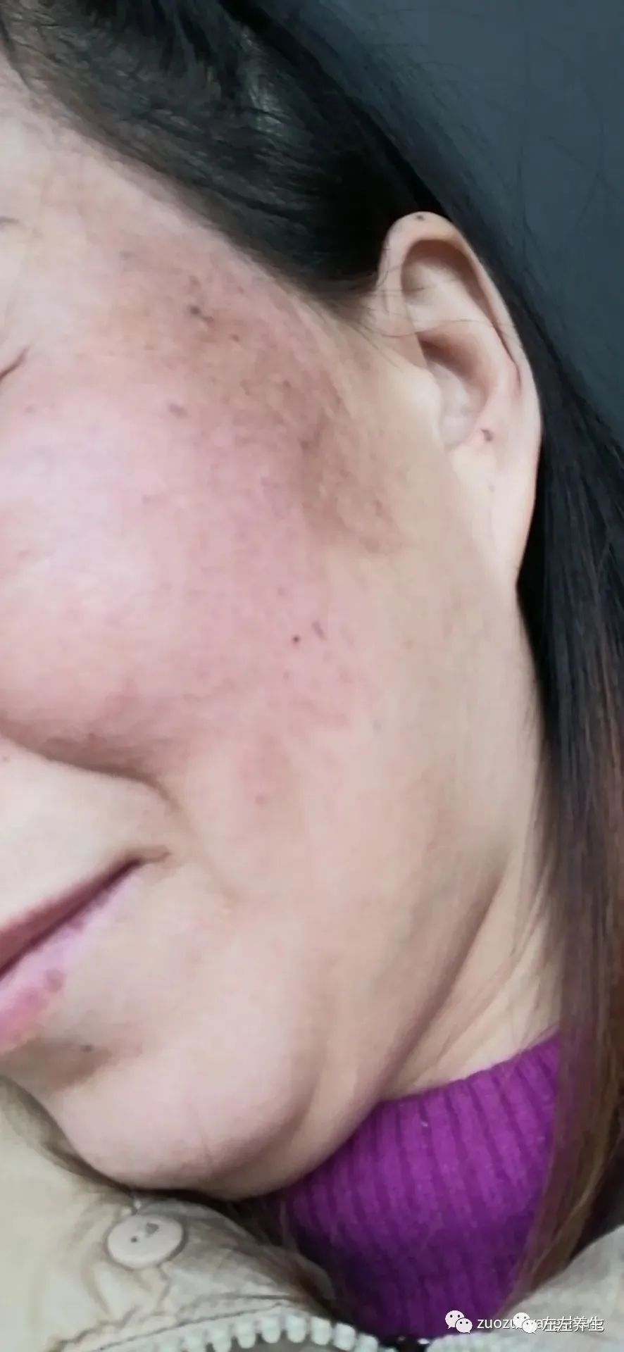 案例分享:脸上严重皮肤过敏调理案例 案例分享:脸上严重皮肤过敏调理案例