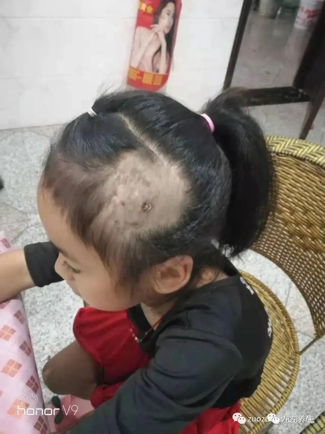 案例分享:小孩毛囊炎反复发作调理案例 案例分享:小孩毛囊炎反复发作调理案例