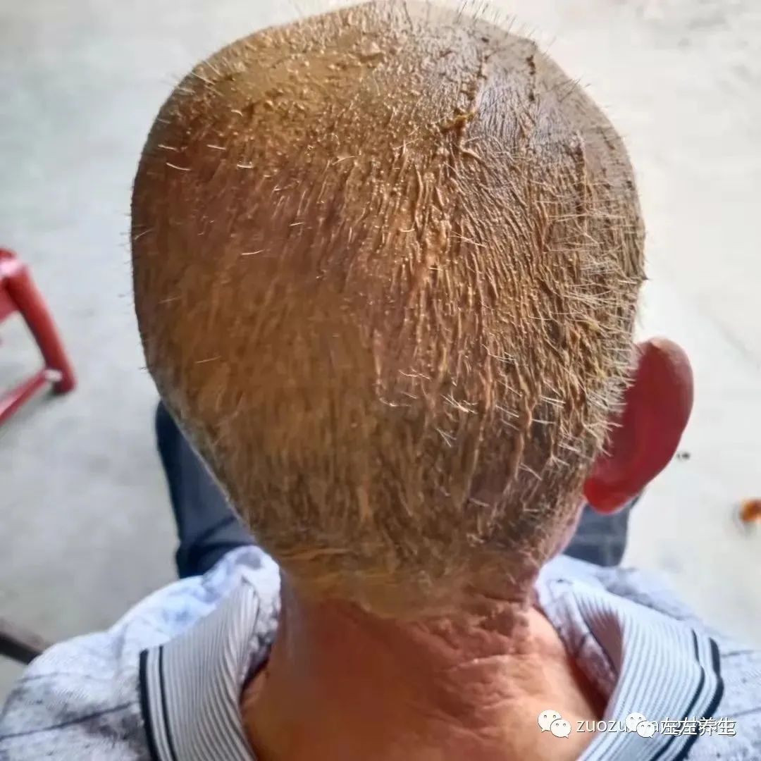 案例分享:85岁老人腿痛、无力,“种”发的案例 案例分享:85岁老人腿痛、无力,“种”发的案例