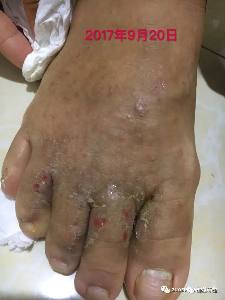 案例分享:全身奇痒无比的湿疹案例 案例分享:全身奇痒无比的湿疹案例