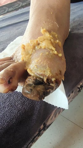 糖尿病脚趾头腐烂后脱落 糖尿病脚趾头腐烂后脱落