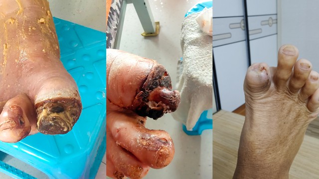 糖尿病脚趾头腐烂后脱落 糖尿病脚趾头腐烂后脱落