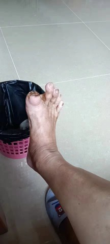 糖尿病脚趾头腐烂后脱落 糖尿病脚趾头腐烂后脱落