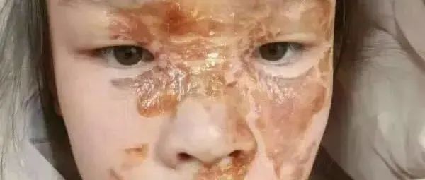 案例分享：花季少女面部烫伤不留疤的调理案例-原始点全球同学网