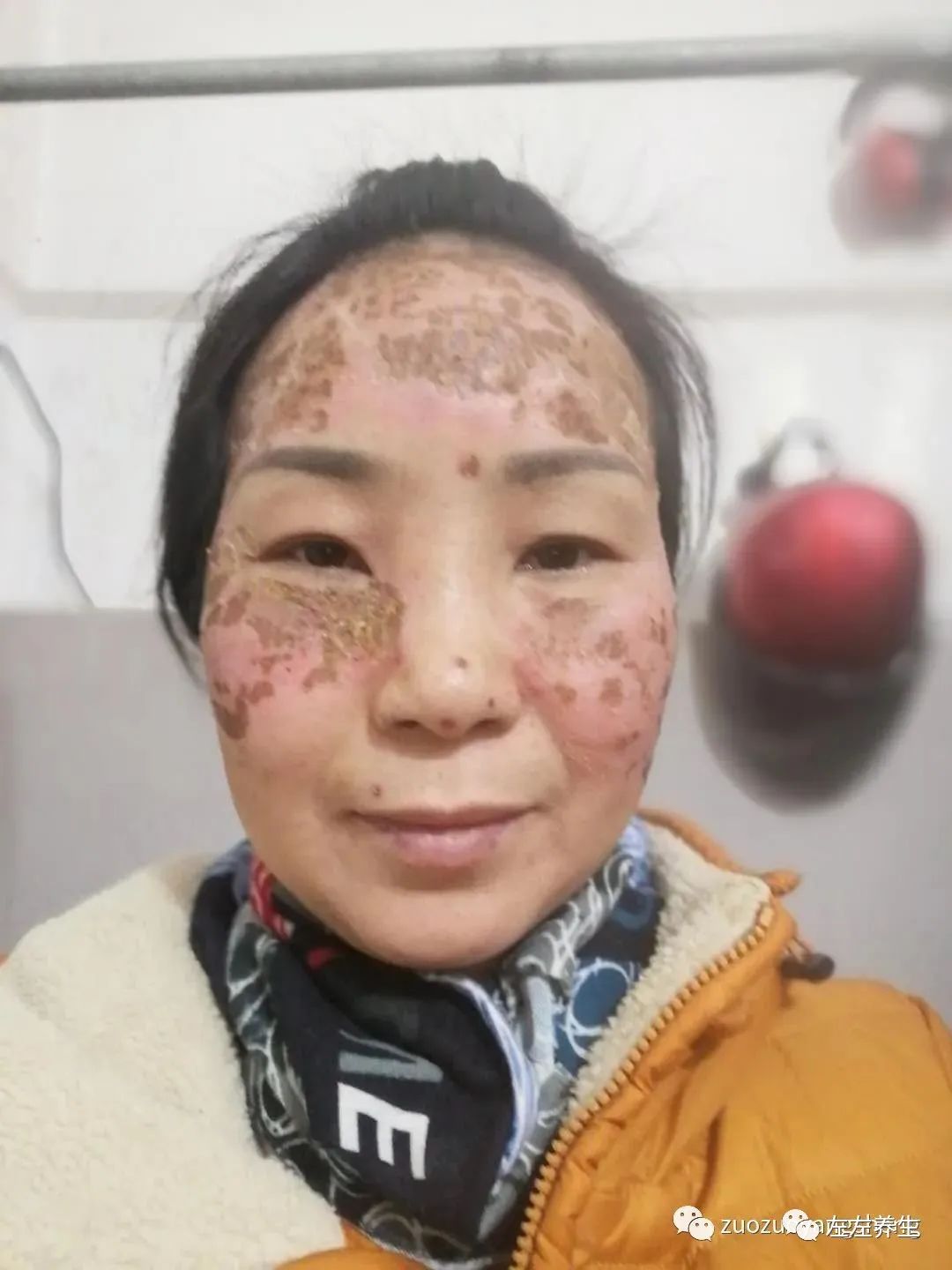 案例分享:脸上严重皮肤过敏调理案例 案例分享:脸上严重皮肤过敏调理案例