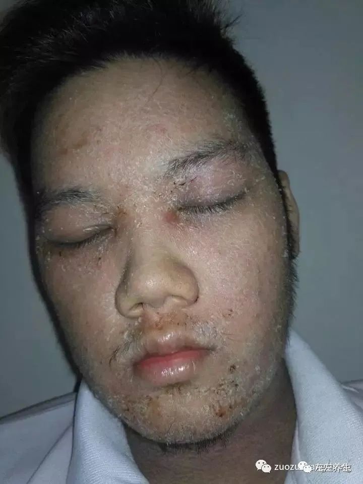 案例分享:马来西亚男孩严重湿疹、十天后大变样 案例分享:马来西亚男孩严重湿疹、十天后大变样