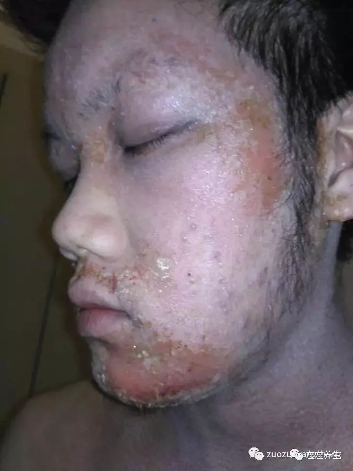 案例分享:马来西亚男孩严重湿疹、十天后大变样 案例分享:马来西亚男孩严重湿疹、十天后大变样