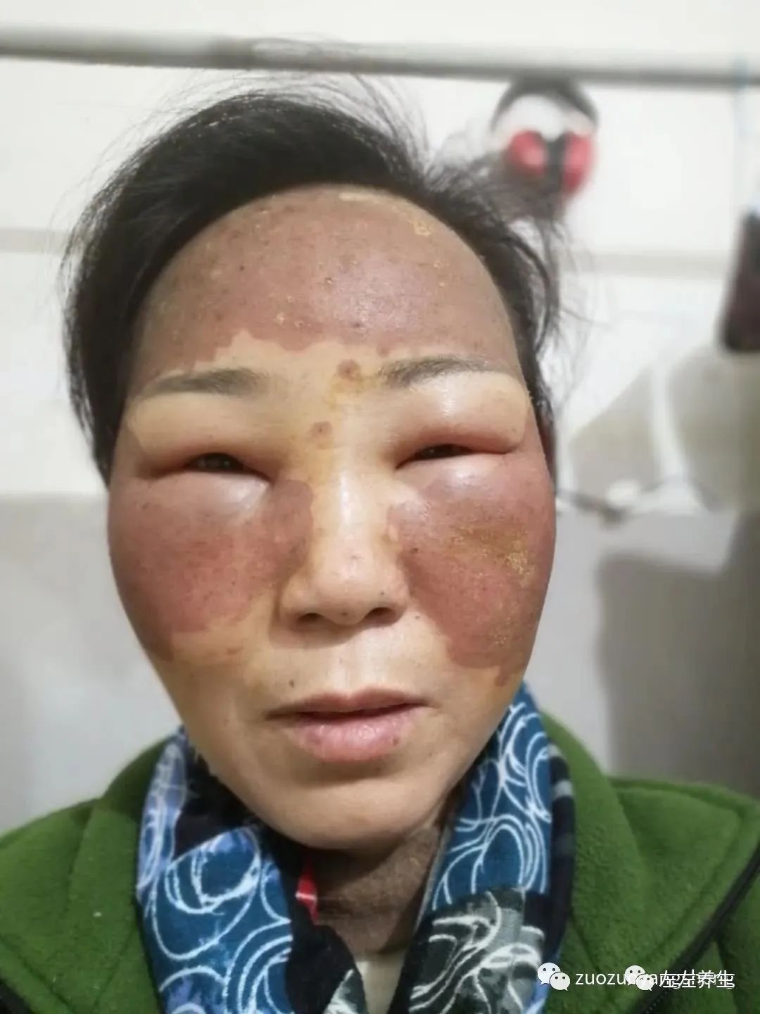 案例分享:脸上严重皮肤过敏调理案例 案例分享:脸上严重皮肤过敏调理案例