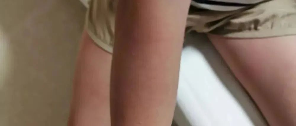 案例分享：突发性过敏全身痒调理案例-原始点全球同学网