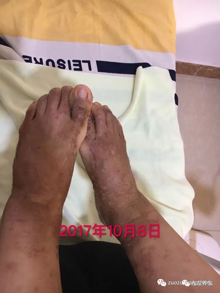 案例分享:全身奇痒无比的湿疹案例 案例分享:全身奇痒无比的湿疹案例