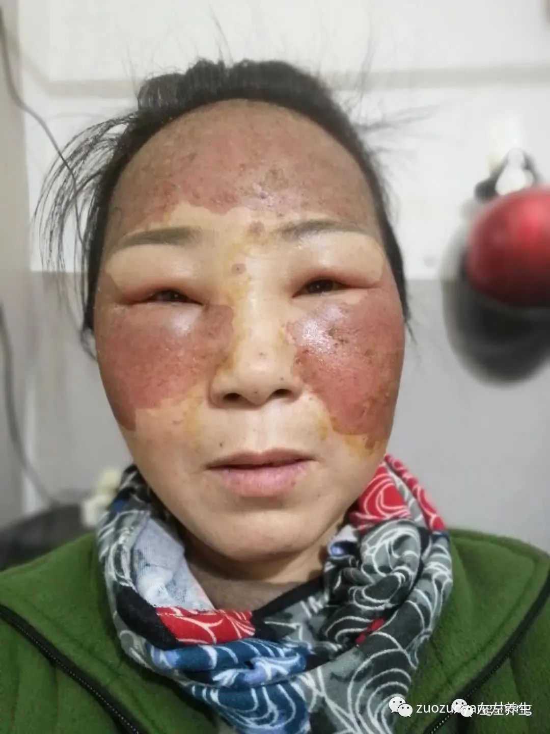 案例分享:脸上严重皮肤过敏调理案例 案例分享:脸上严重皮肤过敏调理案例