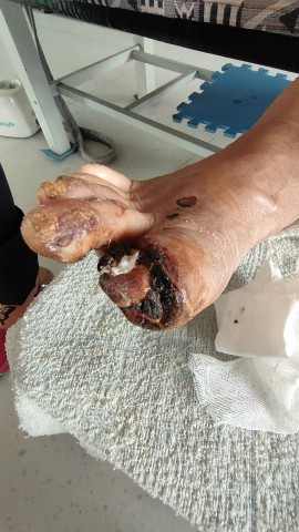 糖尿病脚趾头腐烂后脱落 糖尿病脚趾头腐烂后脱落