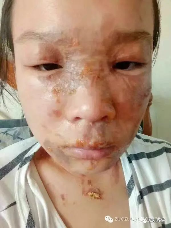案例分享:花季少女面部烫伤不留疤的调理案例 案例分享:花季少女面部烫伤不留疤的调理案例