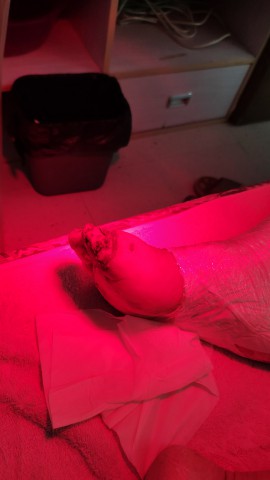 糖尿病脚趾头腐烂后脱落 糖尿病脚趾头腐烂后脱落