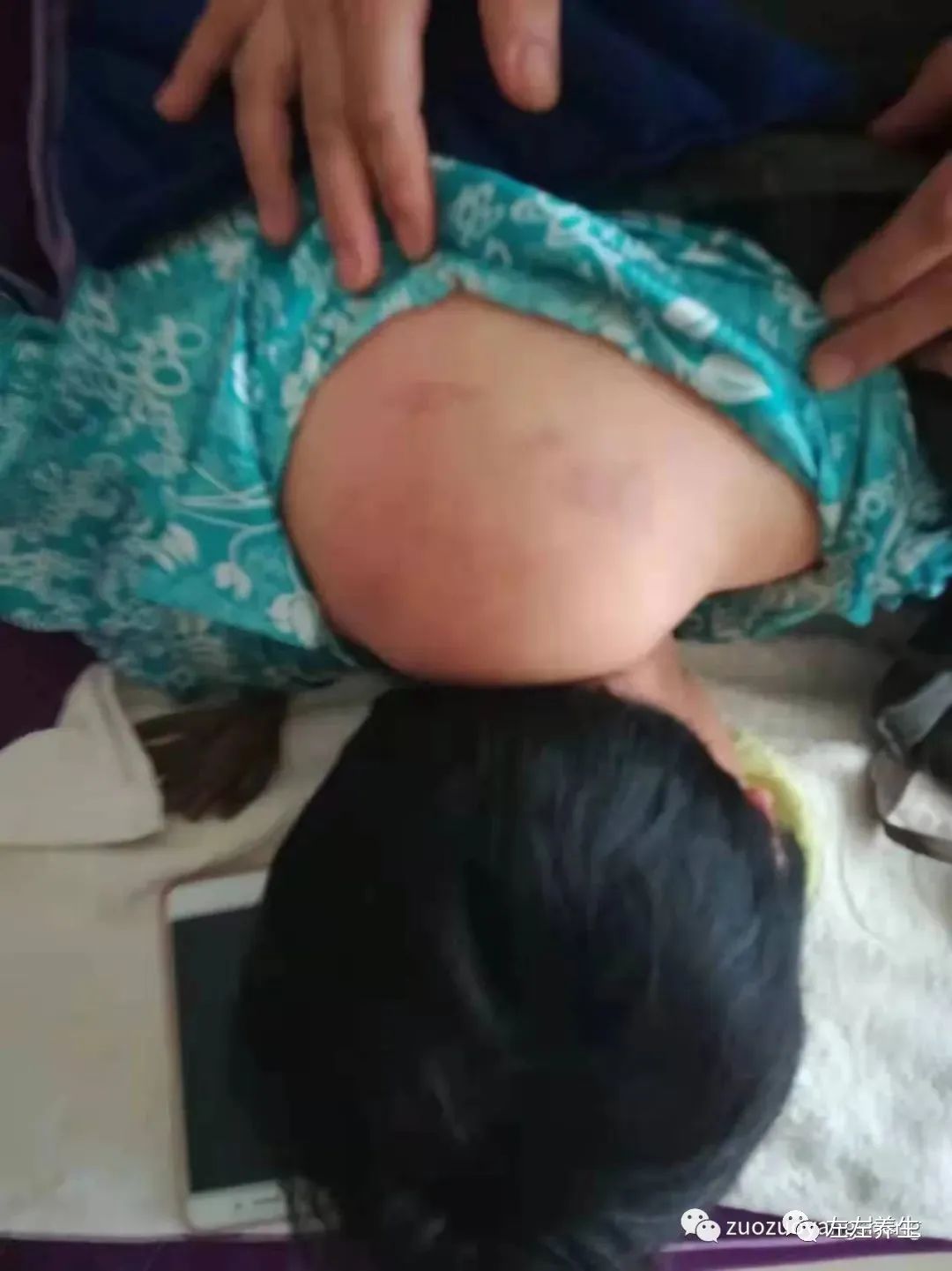 案例分享:双腿无法下蹲以及“富贵包”消除的案例 案例分享:双腿无法下蹲以及“富贵包”消除的案例