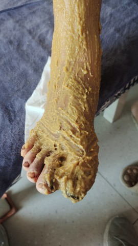 糖尿病脚趾头腐烂后脱落 糖尿病脚趾头腐烂后脱落