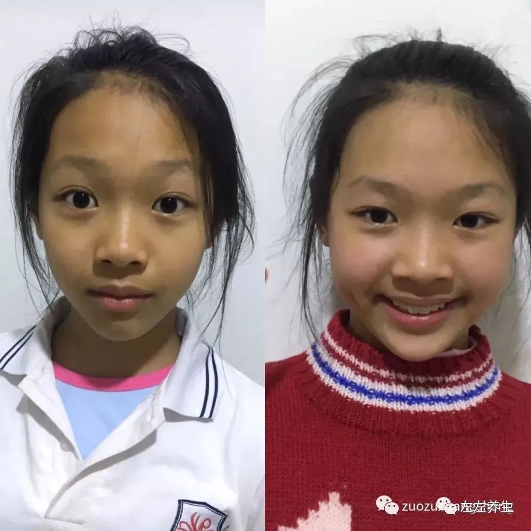 案例分享：儿童全身痒调理案例-原始点全球同学网
