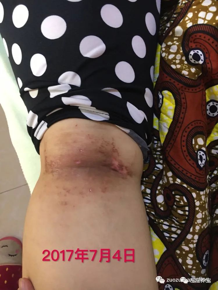 案例分享:全身奇痒无比的湿疹案例 案例分享:全身奇痒无比的湿疹案例