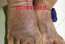 案例分享:全身奇痒无比的湿疹案例-原始点全球同学网