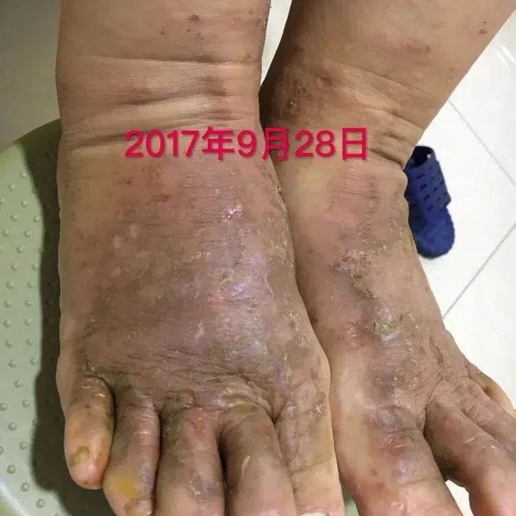 案例分享：全身奇痒无比的湿疹案例-原始点全球同学网