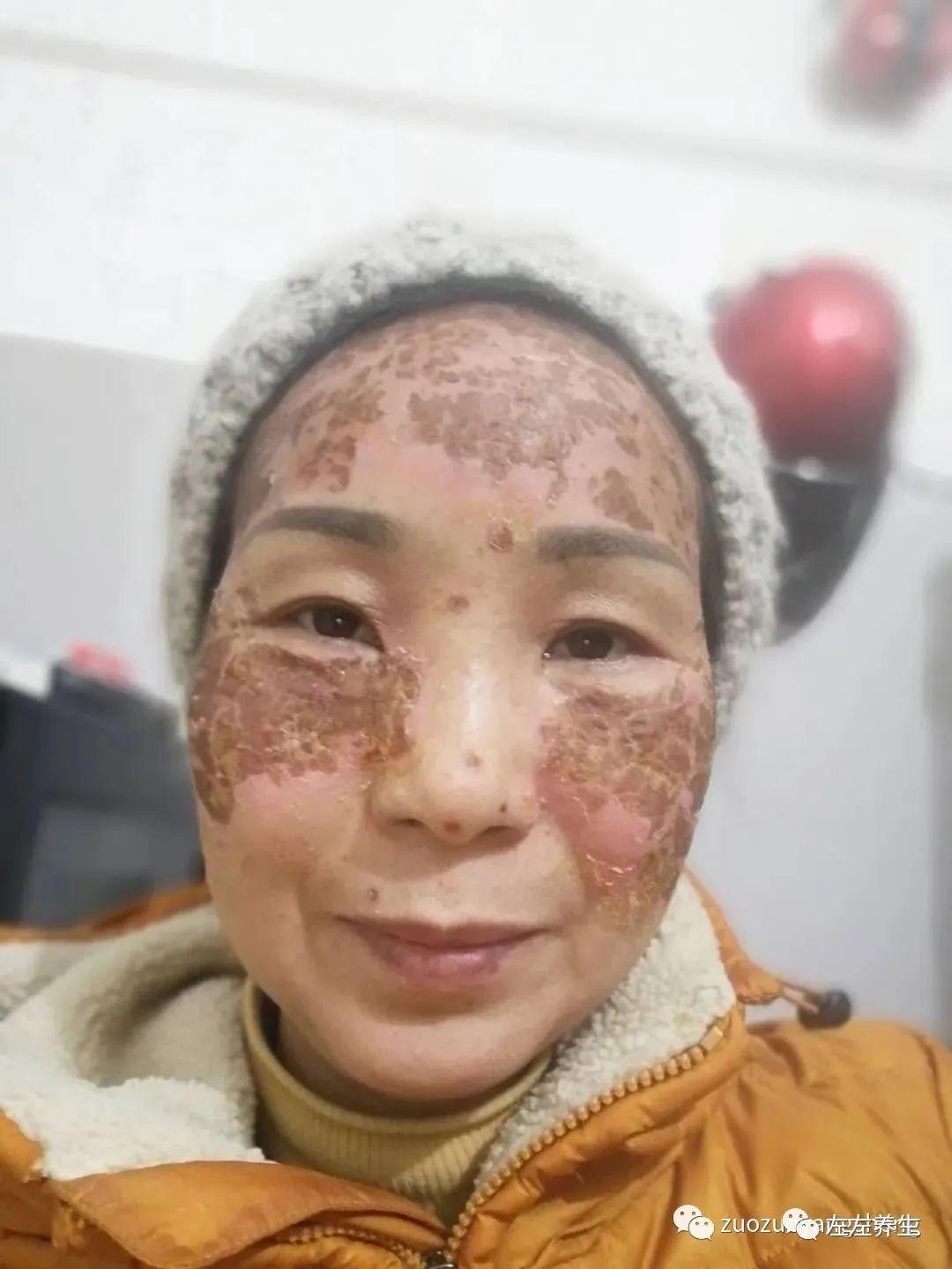 案例分享:脸上严重皮肤过敏调理案例 案例分享:脸上严重皮肤过敏调理案例