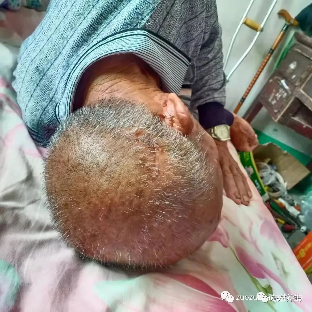 案例分享:85岁老人腿痛、无力,“种”发的案例 案例分享:85岁老人腿痛、无力,“种”发的案例