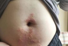 案例分享:腹部奇痒无比湿疹调理案例-原始点全球同学网