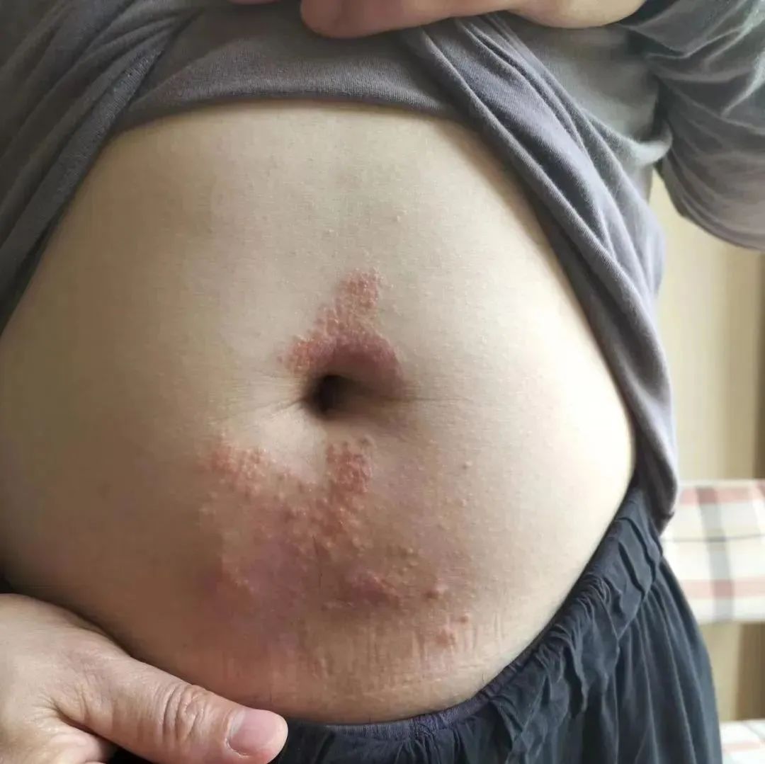 案例分享：腹部奇痒无比湿疹调理案例-原始点全球同学网