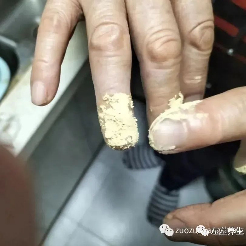 案例分享：手指夹伤后血流不止调理案例-原始点全球同学网