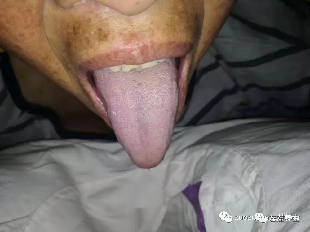 案例分享：70岁老人腹痛（医院初诊可能升结肠癌）飞蛾症、腿抽筋、失眠调理案例