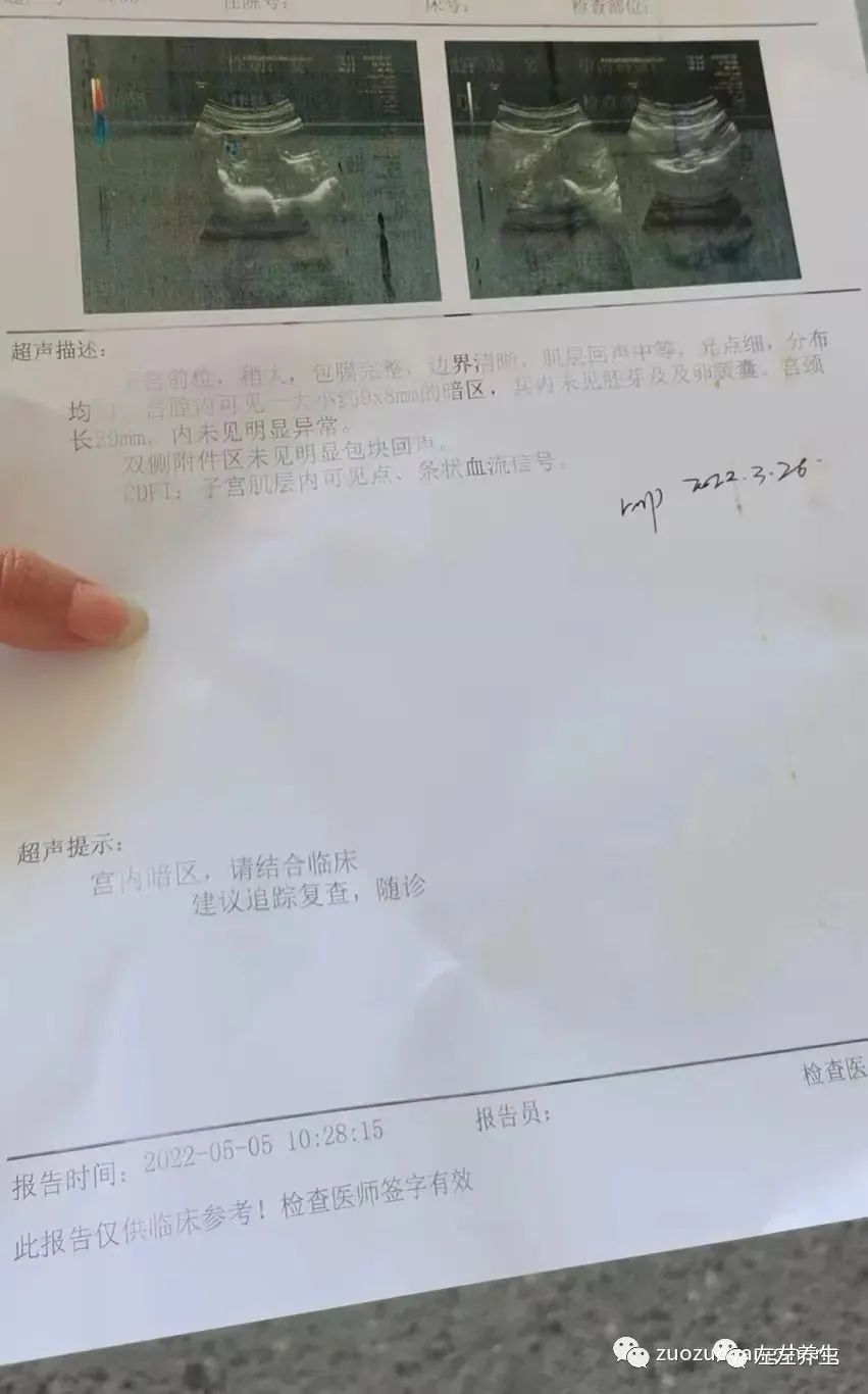 案例分享：胎停排死胎调理案例