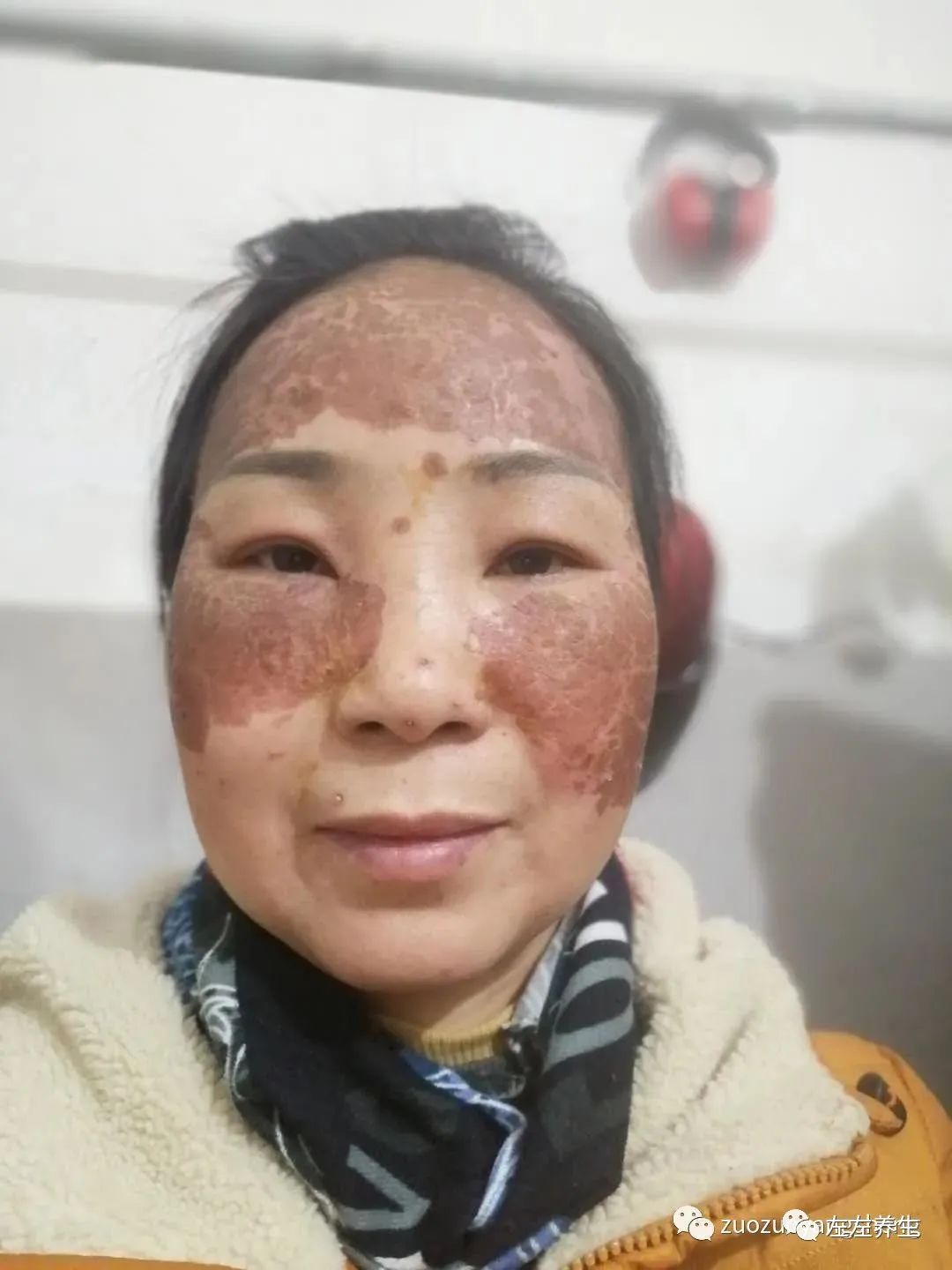 案例分享:脸上严重皮肤过敏调理案例 案例分享:脸上严重皮肤过敏调理案例