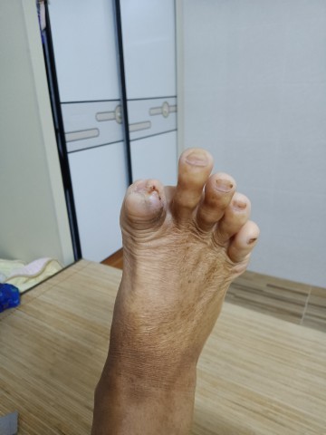 糖尿病脚趾头腐烂后脱落 糖尿病脚趾头腐烂后脱落