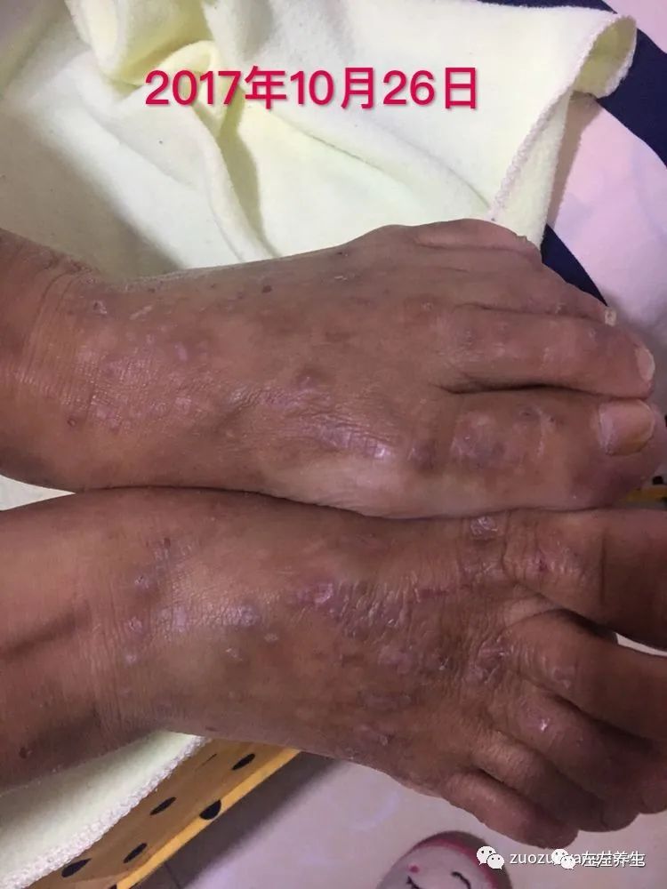 案例分享:全身奇痒无比的湿疹案例 案例分享:全身奇痒无比的湿疹案例