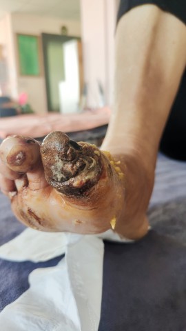 糖尿病脚趾头腐烂后脱落 糖尿病脚趾头腐烂后脱落