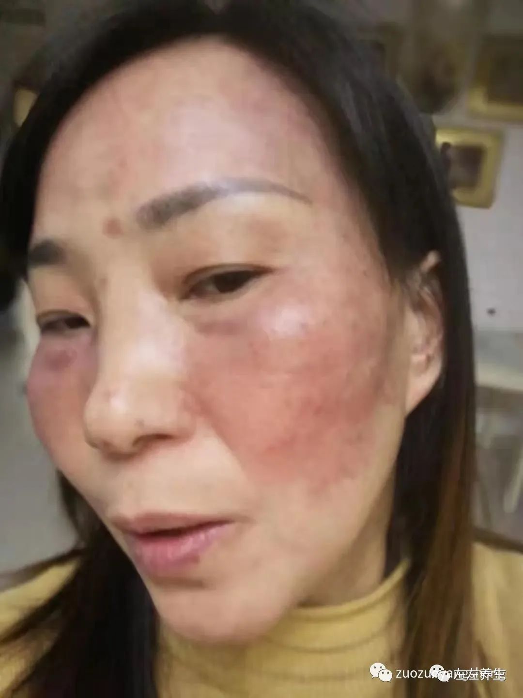 案例分享:脸上严重皮肤过敏调理案例 案例分享:脸上严重皮肤过敏调理案例