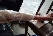 案例分享：85歲老人腿痛、無力，“種”發的案例-原始點全球同學網