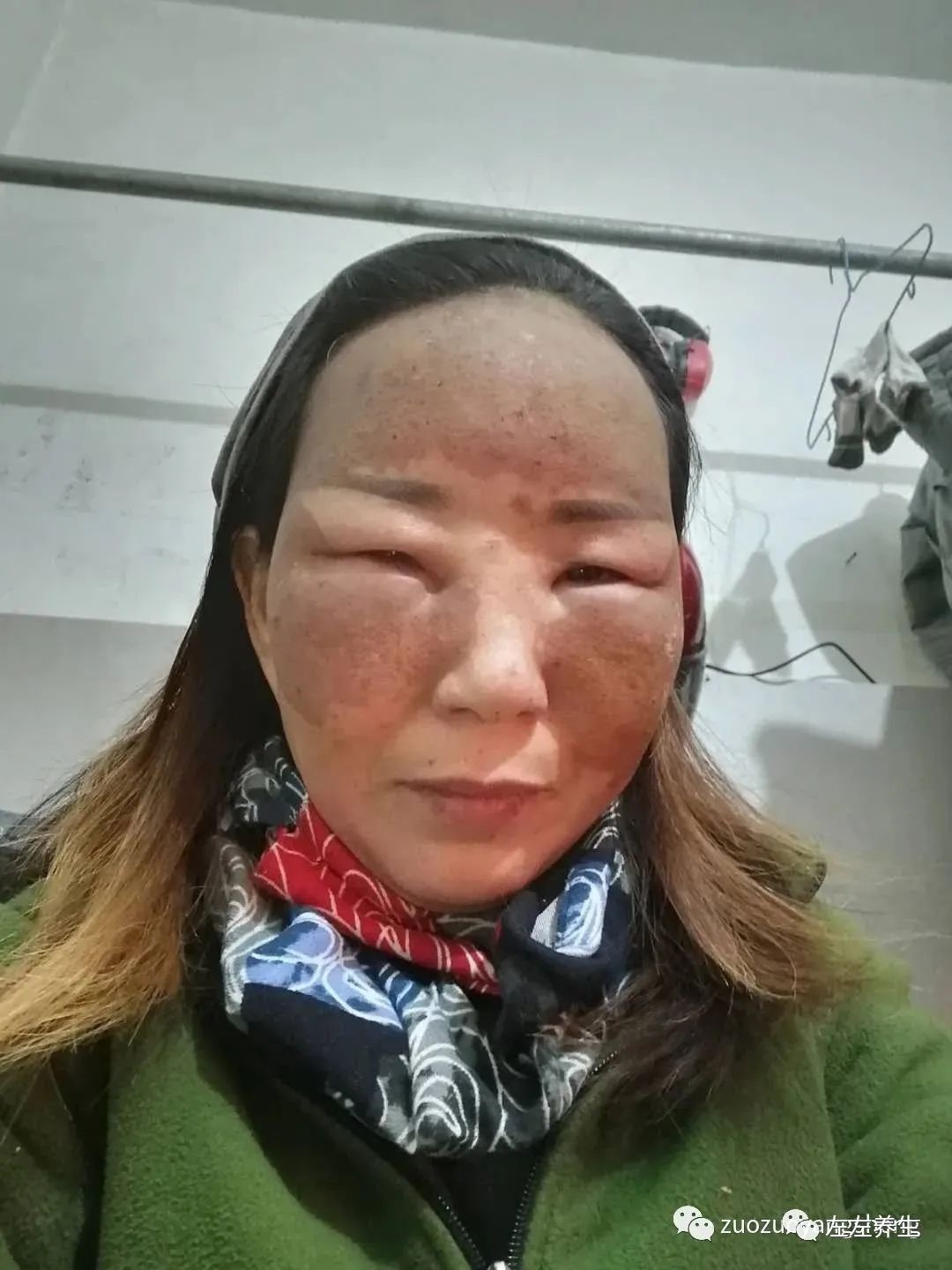 案例分享:脸上严重皮肤过敏调理案例 案例分享:脸上严重皮肤过敏调理案例