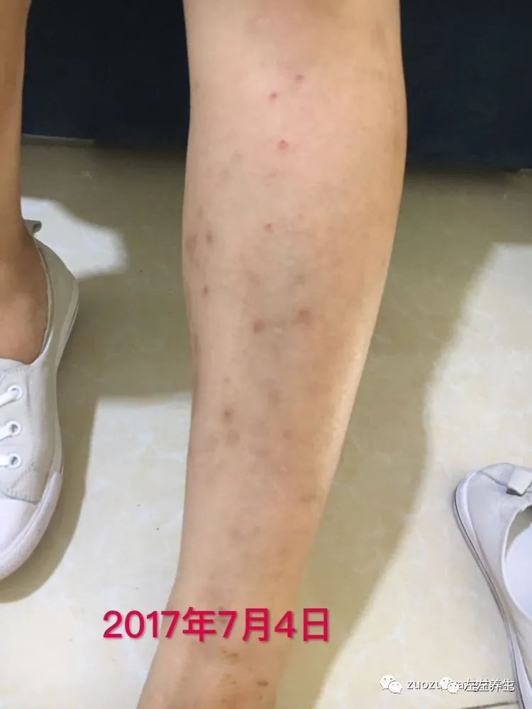 案例分享:全身奇痒无比的湿疹案例 案例分享:全身奇痒无比的湿疹案例