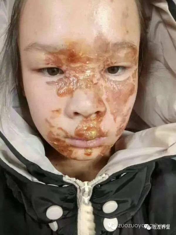 案例分享:花季少女面部烫伤不留疤的调理案例 案例分享:花季少女面部烫伤不留疤的调理案例