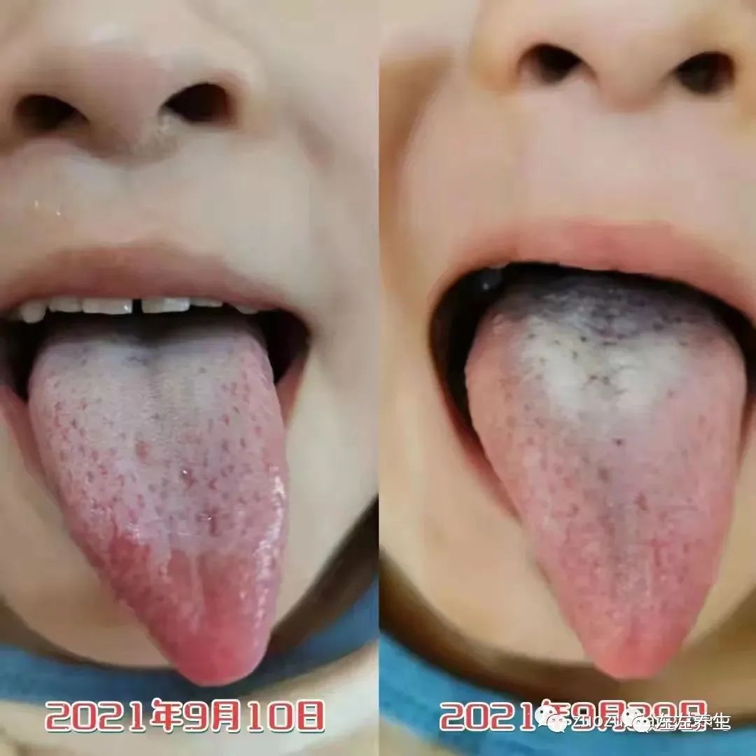 案例分享:小孩癫痫、脑发育不全、轻微自闭调理案例 案例分享:小孩癫痫、脑发育不全、轻微自闭调理案例