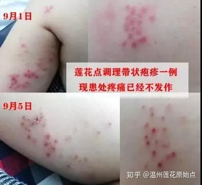 【案例】隔姜灸调理带状疱疹一例-原始点全球同学网