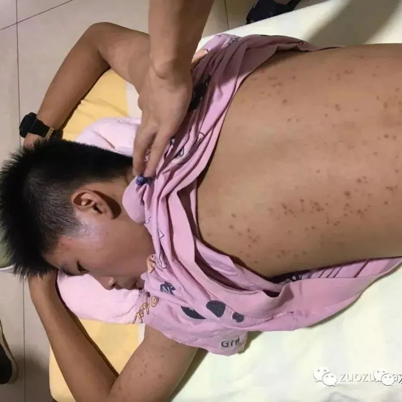 案例分享：14岁少年毛囊炎、全身痒、长痘痘的案例-原始点全球同学网